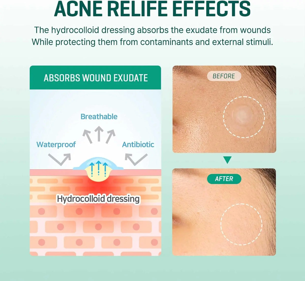 30 days Miracle Clear Spot Patches (18 patchs) SOME BY MI